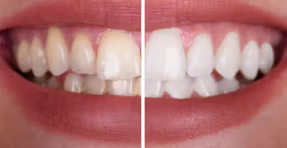 Antes del blanqueamiento dental