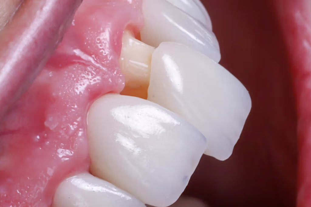 Resultado de corona dental